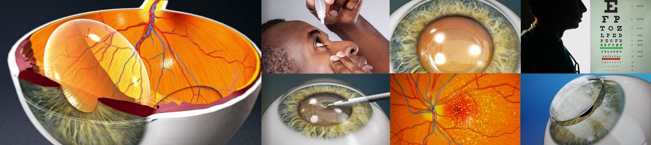 Various images from ophthalmology patient education videos