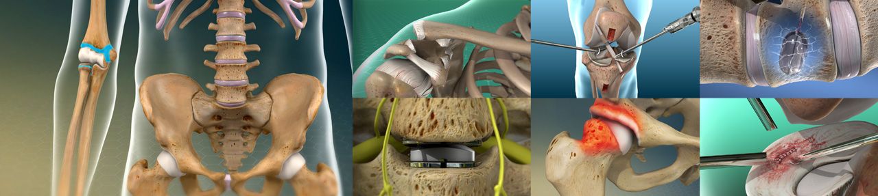 Various images from orthopedic patient education videos