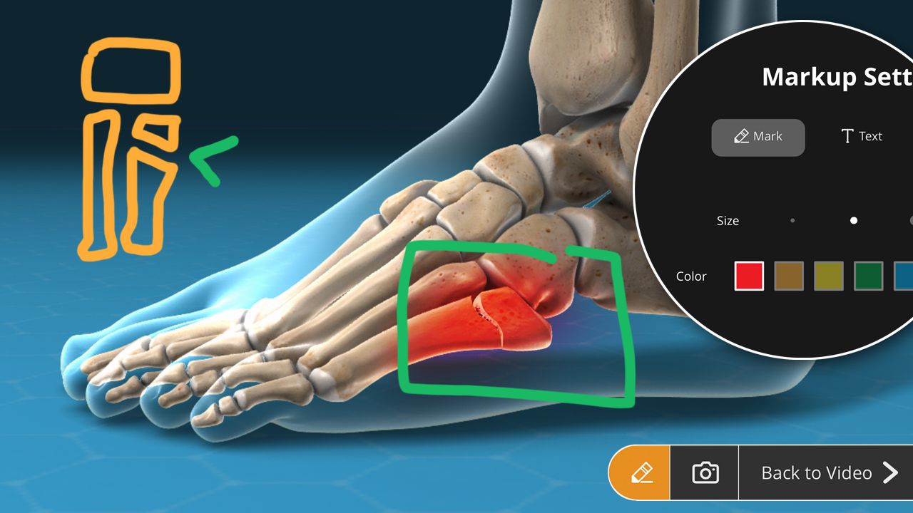 Drawing on a video showing metatarsal joint pain with ViewMedica On-Demand.