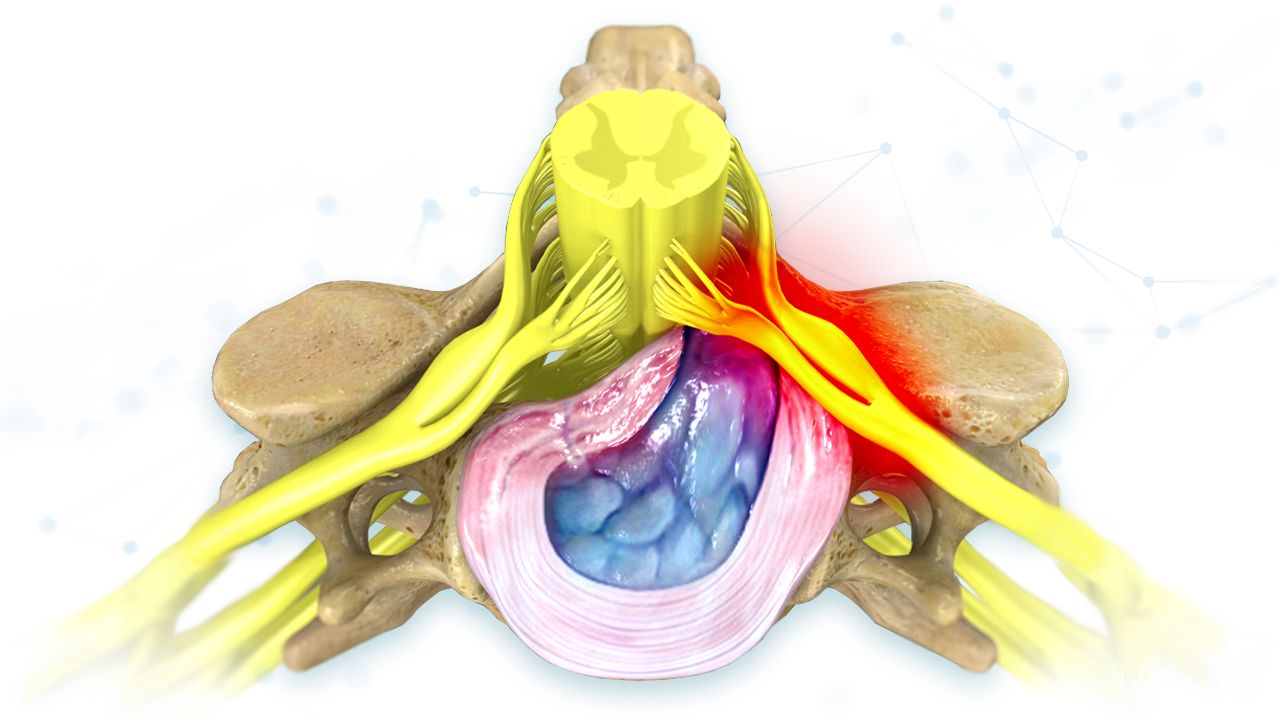 A herniated disc pinches a spinal nerve